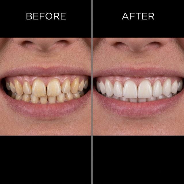 Antes y después - Rehabilitación Oral Completa